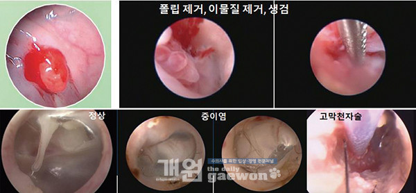 [그림 4] Otoscope을 이용한 시술 장면 *강의자료 발췌