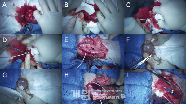 [그림 3] 피하 요관 우회술 수술 과정.