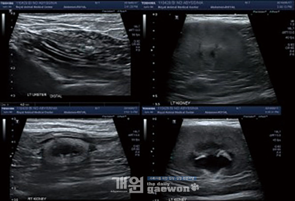[그림 9] 좌측 renal length는 5.3cm 정도로 크게 관찰. Renal cortex는 hyperechoic, corticomedullary definition이 indistinct. Renal pelvis는 1cm 정도로 severe하게 dilation. 좌측 ureter는 2mm 미만의 dilation으로 관찰. Uretero-vesical junction 위치로 4mm 정도 크기의 mineralization 음영. 좌측 신장 caudal 측면으로 retroperitoneal fat echogenicity는 증가, 소량의 free fluid가 동반.